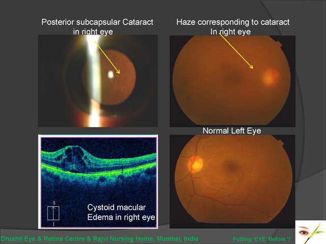 DrushtiEye and Retina Center:-Posterior Sub Capsular Cataract With 