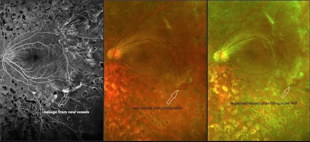 Role of Pan Retinal Photocogulation in present era of anti-VEGF injection