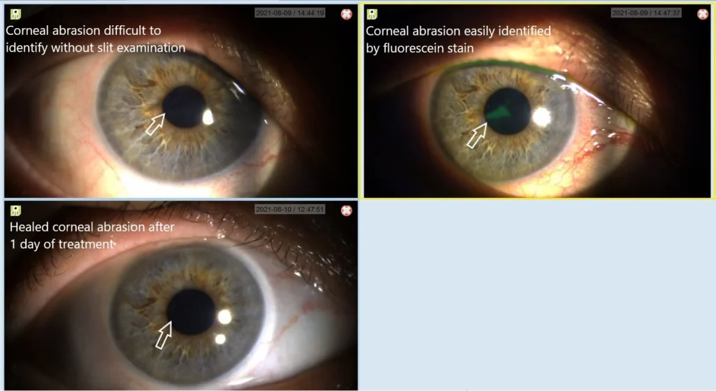 Corneal Abrasion Role Of Fluorescein Staining