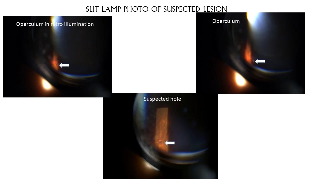 Usefullness Or Ultrawide Field Fundus Photo With Periferal Swept Source Oct