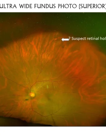 Usefullness Or Ultrawide Field Fundus Photo With Periferal Swept Source Oct
