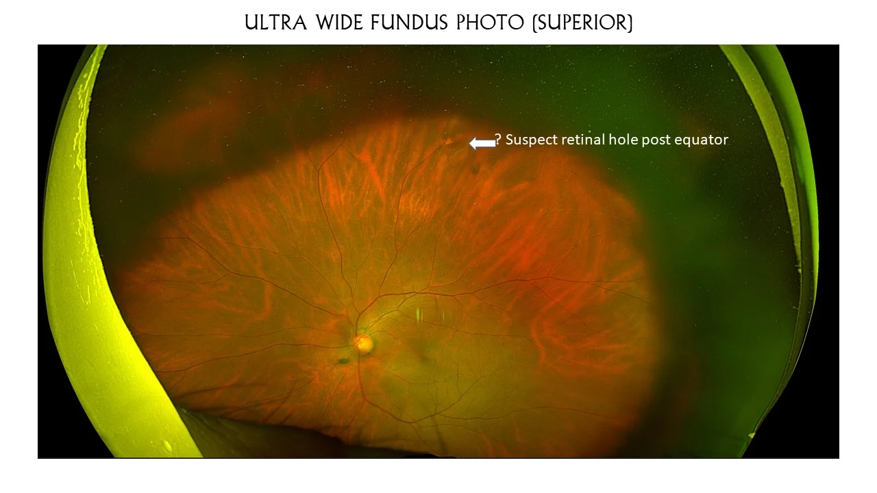 Usefullness Or Ultrawide Field Fundus Photo With Periferal Swept Source Oct