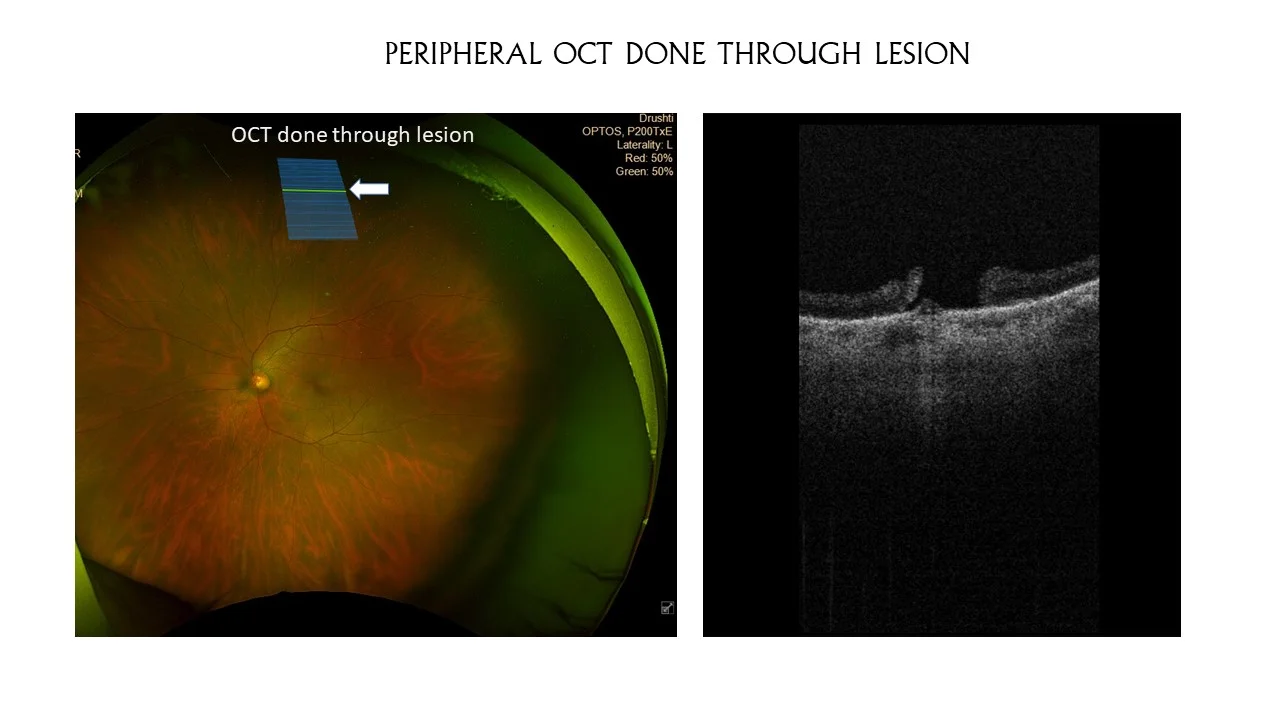 Usefullness Or Ultrawide Field Fundus Photo With Periferal Swept Source Oct