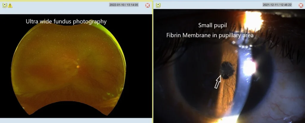 Usefullness Of Ultrawide Field Fundus