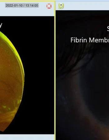 Usefullness Of Ultrawide Field Fundus