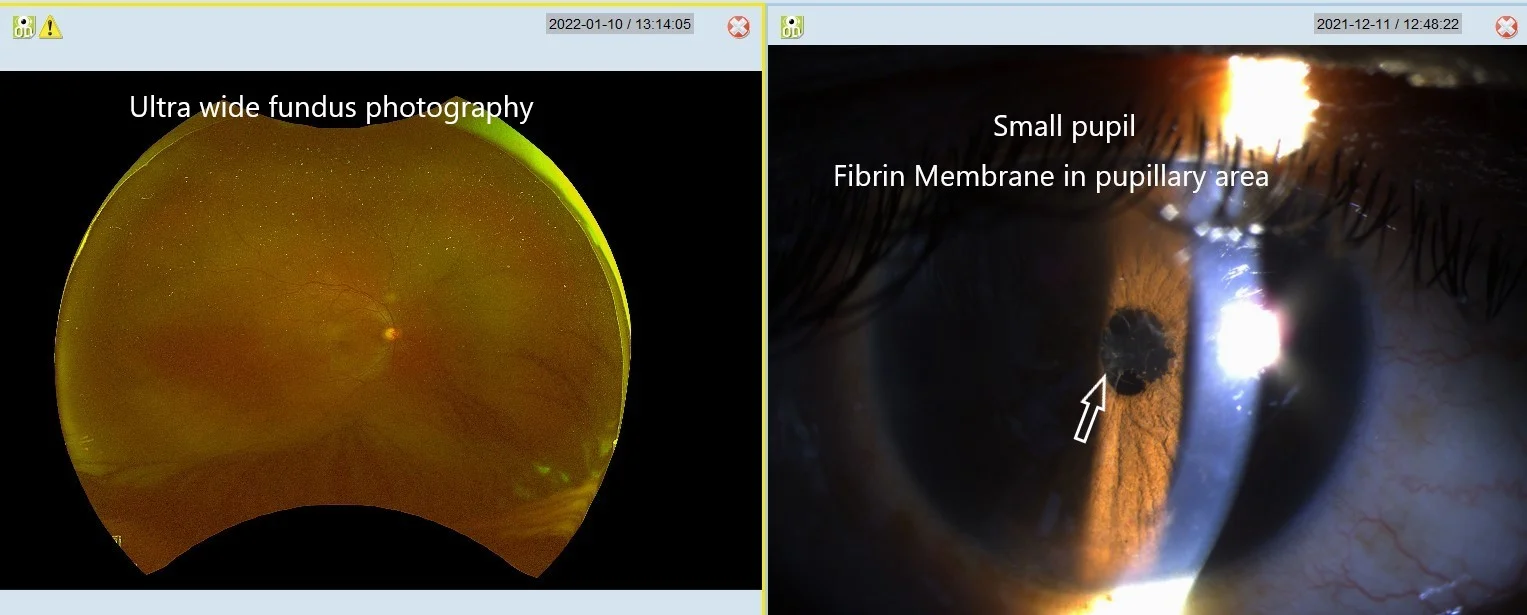 Usefullness Of Ultrawide Field Fundus