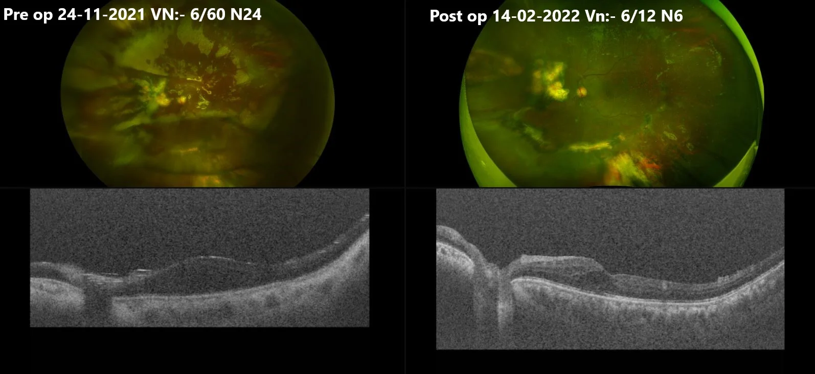 Importance Of Identifying & Treating Cause Of CME.​