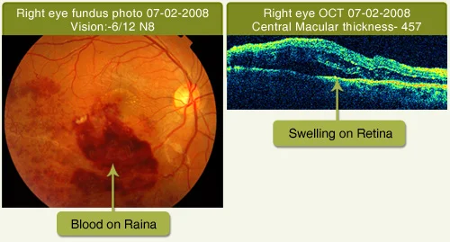 Branch Retinal Vein Occlusion (Without Any Treatment)