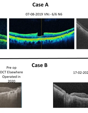 Is Observation Better Than Surgery