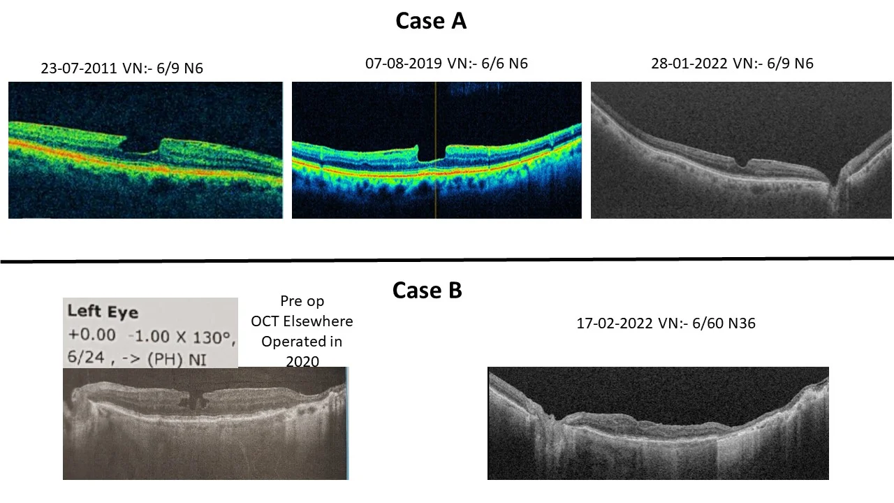 Is Observation Better Than Surgery