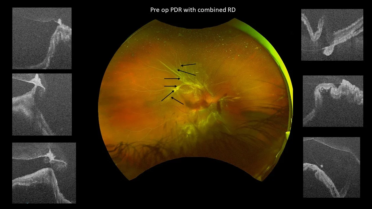 Combined Retinal Detachment