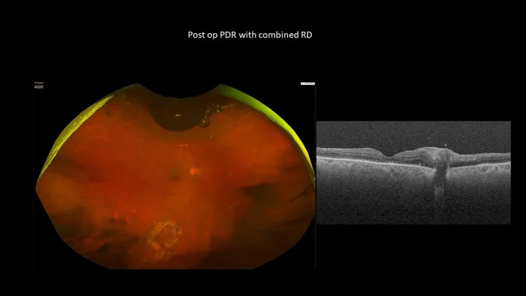 Combined Retinal Detachment