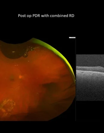 Combined Retinal Detachment