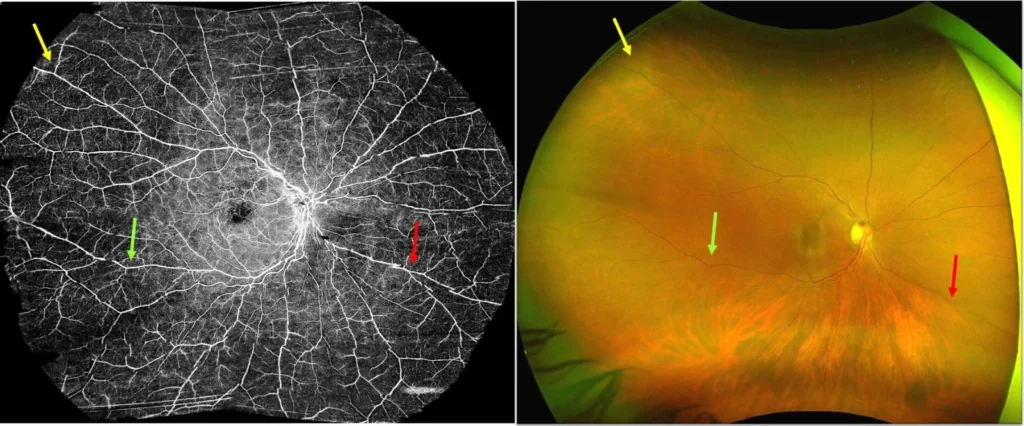 Montage Ultrawidefield oct A VS Optos ultrawide fundus foto