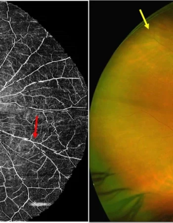 Montage Ultrawidefield oct A VS Optos ultrawide fundus foto