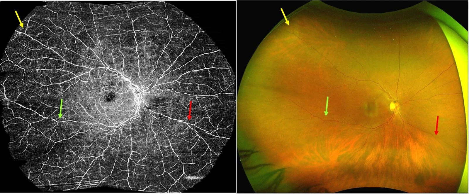 Montage Ultrawidefield oct A VS Optos ultrawide fundus foto