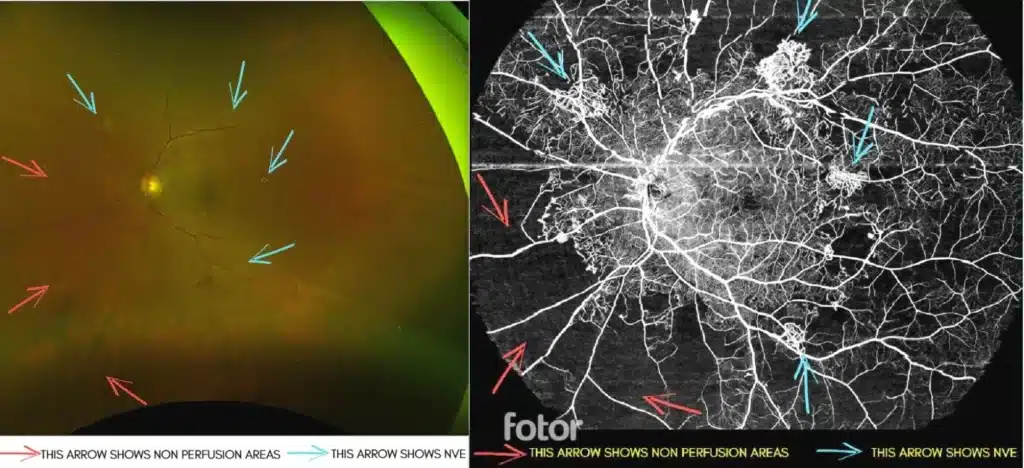 Ultra wide field swept source oct A , comparing it with Optos ultra wide fundus photo