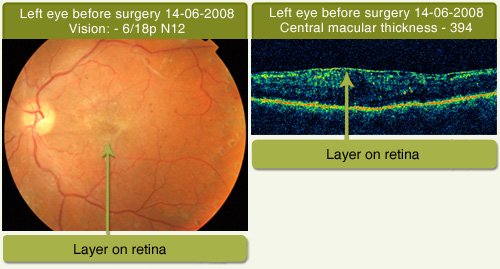 Macular Pucker