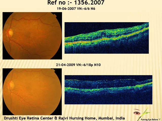 Macular Pucker Case2