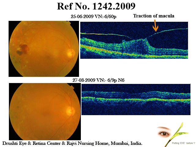 Diabetic Maculopathy With Taut Posterior Hyaloid