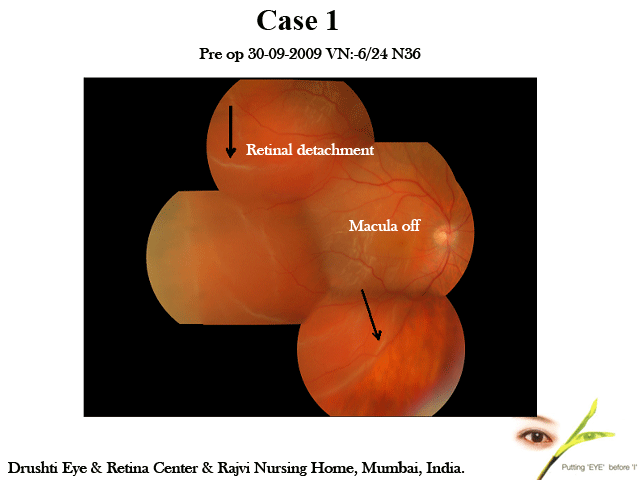 Yag Laser For After Cataract In Myopic Patients
