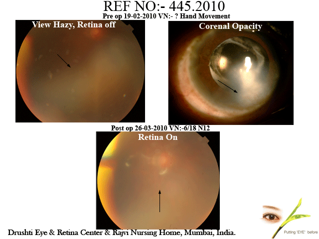 Corneal Opacity with Detachment