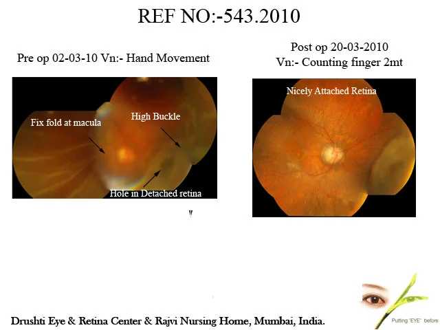 Case Of Recurrent Retinal Detachment in One eyed patient