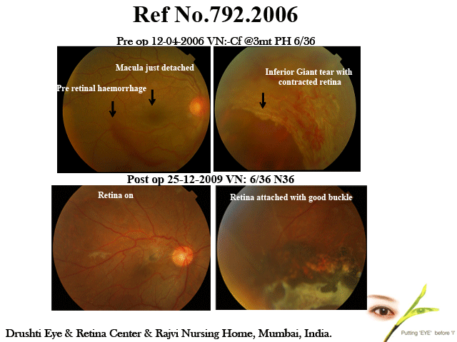 Case of Multiple Retinal Detachment surgries