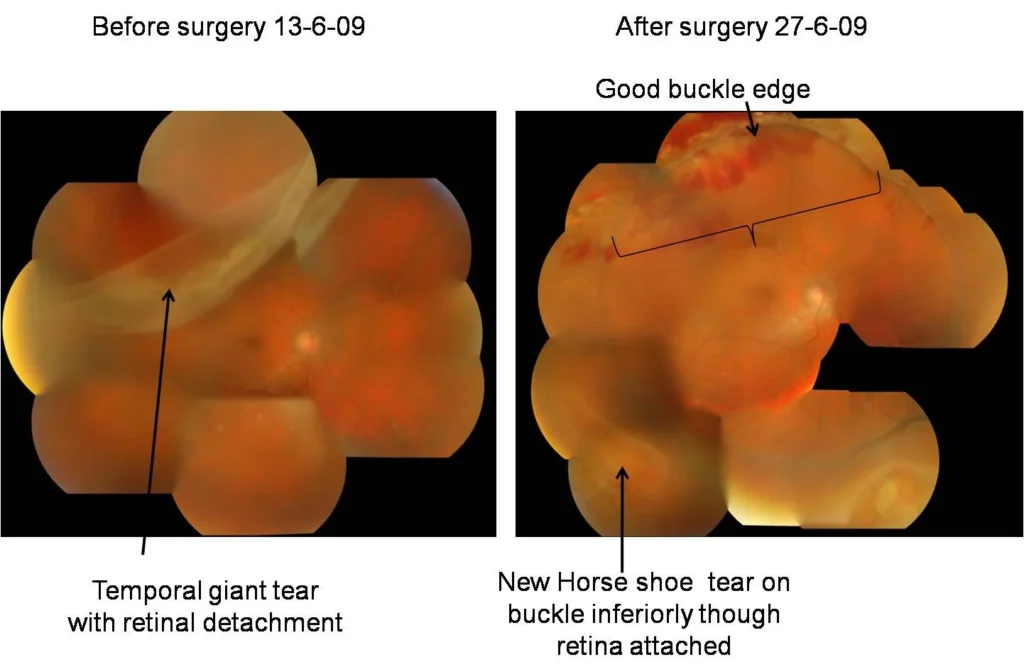 Case of Giant Tear with Retinal Detachment