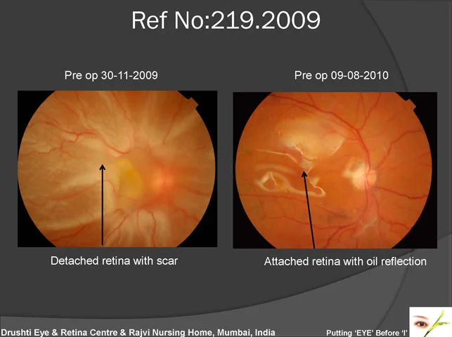 Management of Complicated Retinal Detachment