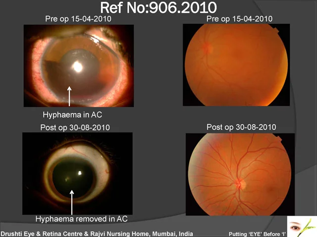 Traumatic Hyphema (Blood In Anterior Part Of The Eye)