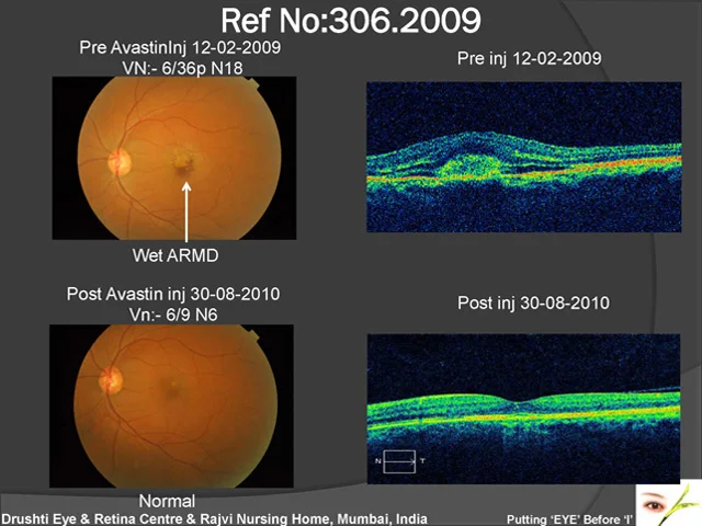 Age Related Macular Degeneration Wet Type Treated With Inj. Avastin
