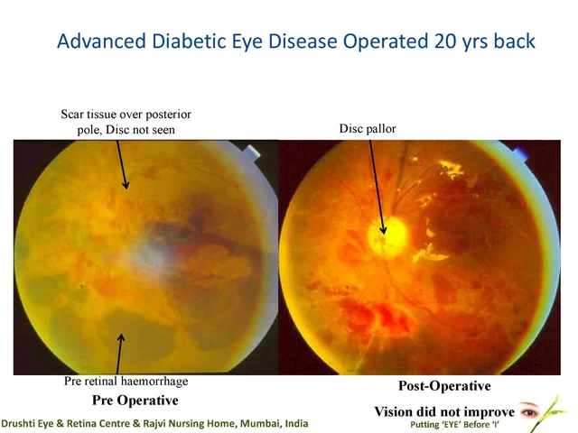 Advanced Diabetic Eye Disease Operated 20 Yrs Back