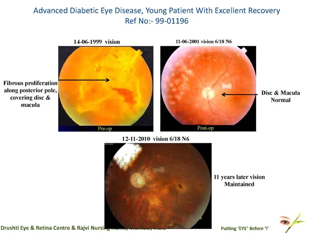 Advanced Diabetic Eye Disease, Young Patient With Excellent RecoveryRef No:- 99-01196
