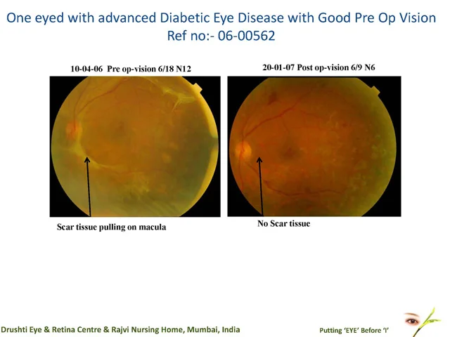 One Eyed With Advanced Diabetic Eye Disease With Good Pre Op Vision Ref No: - 06-00562