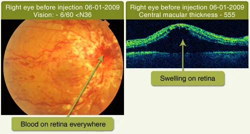 Central Retinal Vein Occlusion Treated With Intravitreal Injection