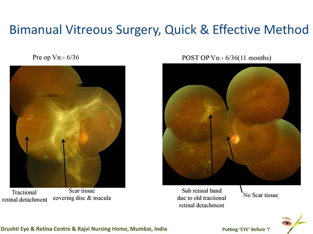 Bimanual Vitreous Surgery, Quick & Effective Method
