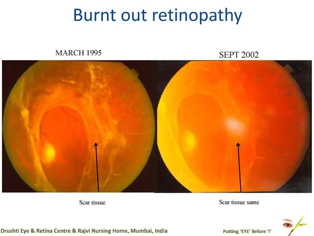 Burnt Out Retinopathy