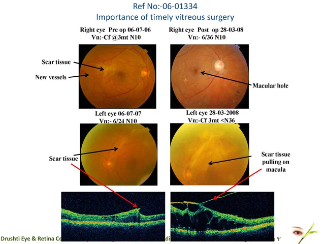 Ref No:-06-01334 Importance Of Timely Vitreous Surgery