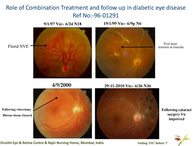 Role of Combination Treatment and follow up in diabetic eye diseaseRef No:-96-01291