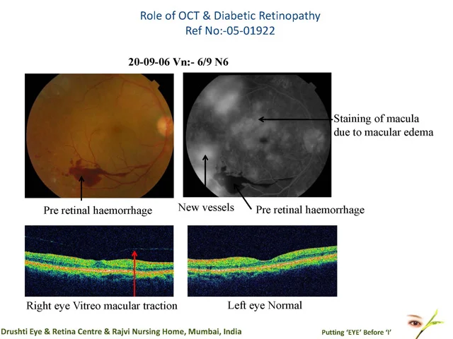Role Of Oct & Diabetic RetinopathyRef No:-05-01922