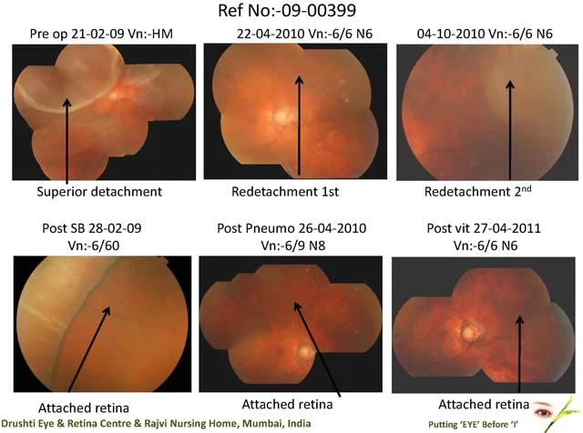 Multiple Surgeries For Retinal Detachment
