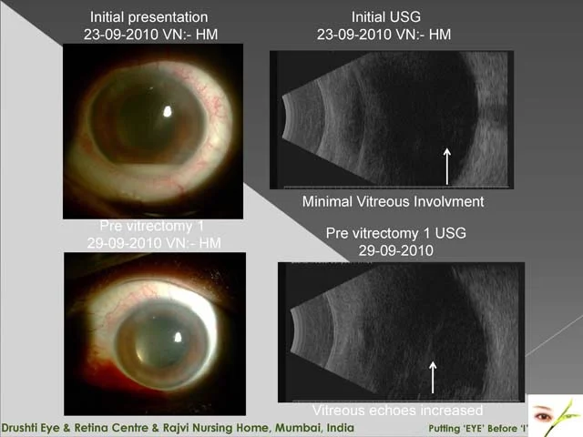 Enthusiastic Treatment For Post Operative Endopthalmitis