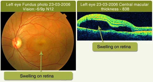 Central Serous Retinopathy