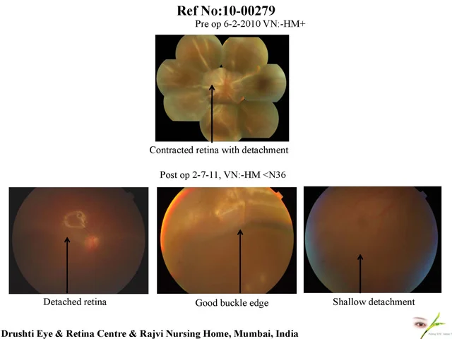 Delay In Treatment Of Re-detachment Leads To Failure Or Partial Sucess