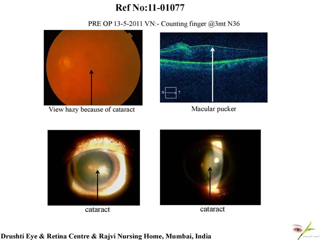Combined Retinal Surgery For Macular Pucker