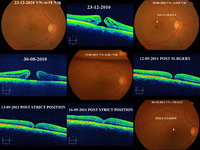 Macular Hole