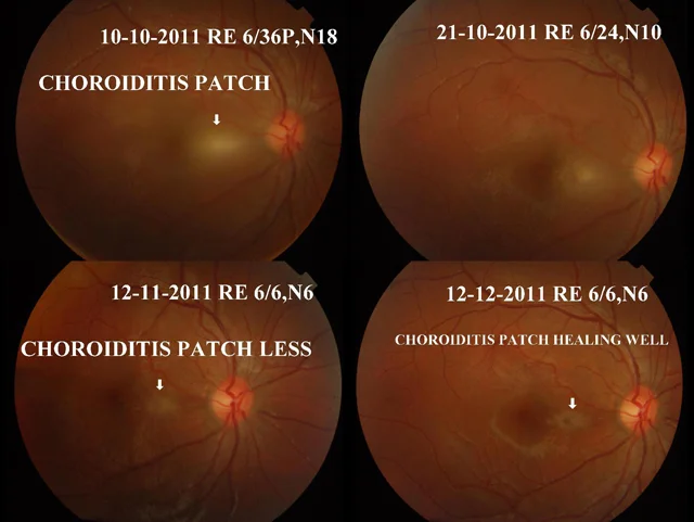 Toxoplasma Retinitis Ref No:-11-02103