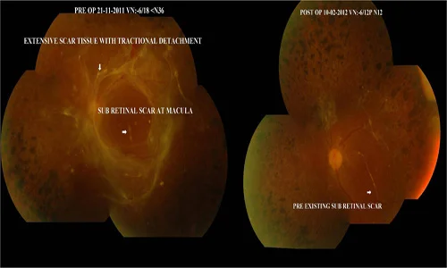 A Case Of One Eyed Proliferative Diabetic Retinopathy