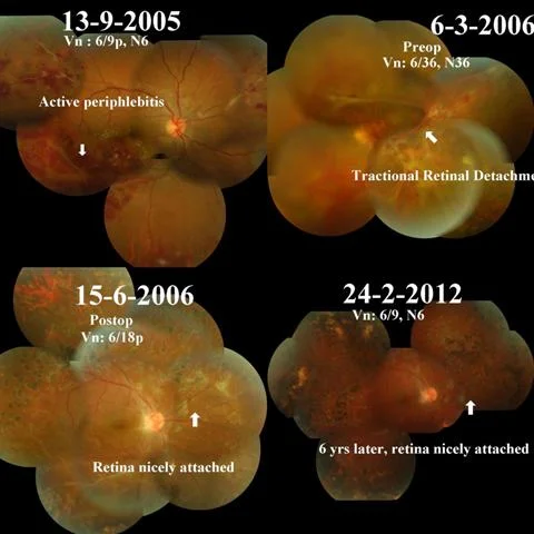 Eale's Disease Treated With Surgery